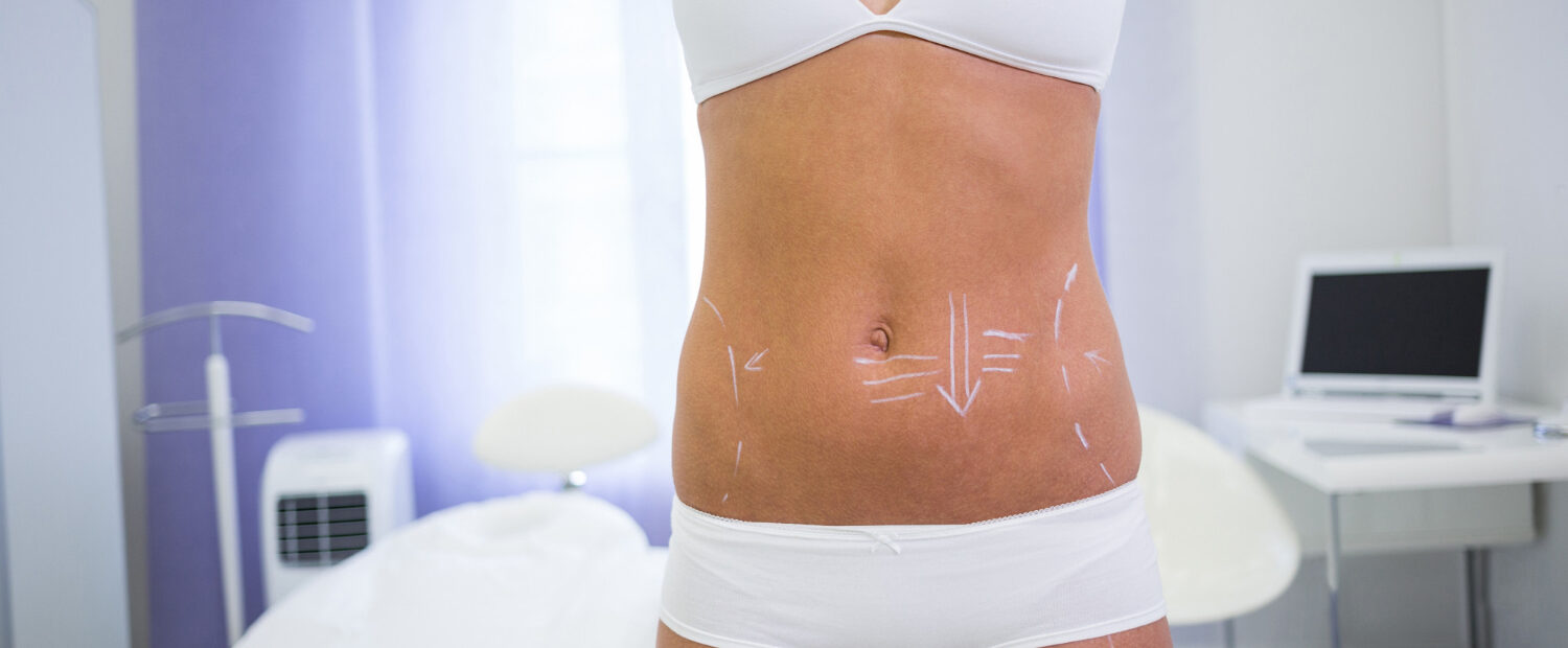 Abdômen de mulher em clínica estética, com marcações feitas com caneta para avaliação de procedimento corporal.